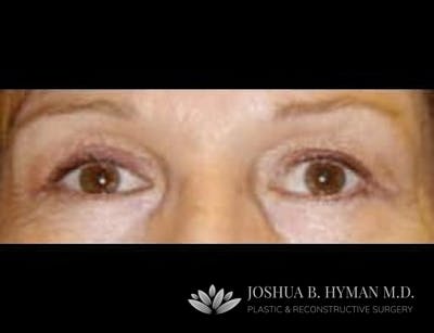 Blepharoplasty Before & After Gallery - Patient 58232304 - Image 2