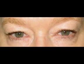 Blepharoplasty Before & After Gallery - Patient 58232306 - Image 1
