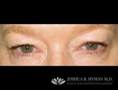 Blepharoplasty Before & After Gallery - Patient 58232306 - Image 1