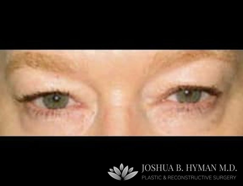 Blepharoplasty Before & After Gallery - Patient 58232306 - Image 1