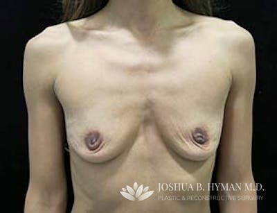 Breast Augmentation Before & After Gallery - Patient 58232307 - Image 1