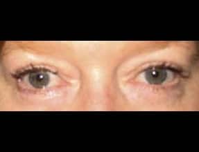 Blepharoplasty Before & After Gallery - Patient 58232306 - Image 2