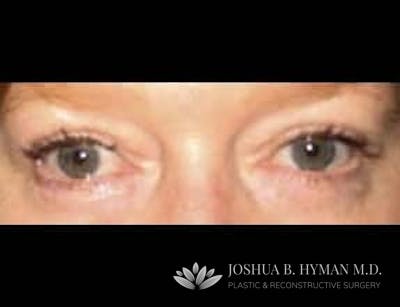 Blepharoplasty Before & After Gallery - Patient 58232306 - Image 2