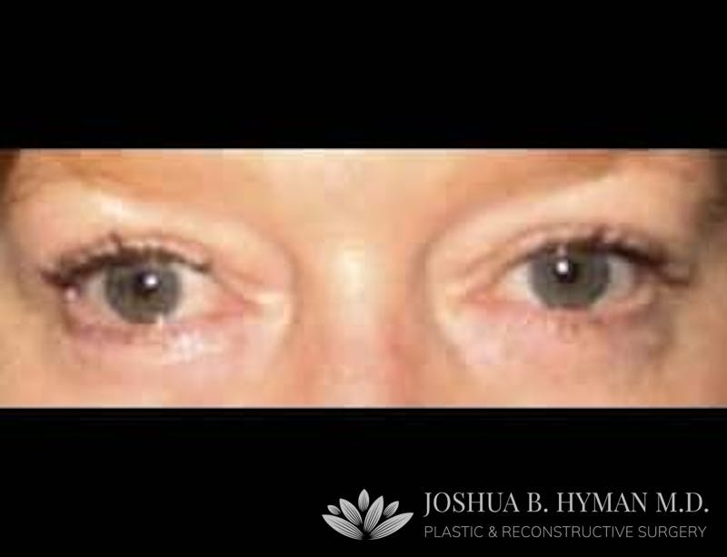Blepharoplasty Before & After Gallery - Patient 58232306 - Image 2