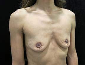 Breast Augmentation Before & After Gallery - Patient 58232307 - Image 3