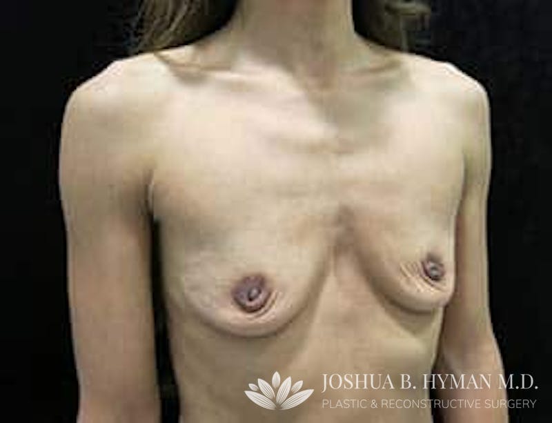 Breast Augmentation Before & After Gallery - Patient 58232307 - Image 3