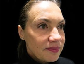 Rhinoplasty Before & After Gallery - Patient 58232323 - Image 1