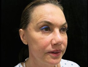 Rhinoplasty Before & After Gallery - Patient 58232323 - Image 2