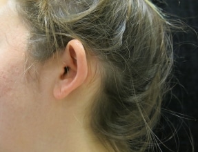 Otoplasty Before & After Gallery - Patient 58232325 - Image 1