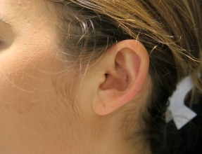 Otoplasty Before & After Gallery - Patient 58232325 - Image 2