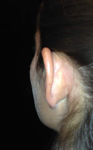 Otoplasty Before & After Gallery - Patient 58232329 - Image 1