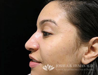 Rhinoplasty Before & After Gallery - Patient 58232330 - Image 1