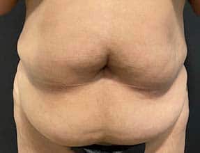 Abdominoplasty Before & After Gallery - Patient 58232328 - Image 1