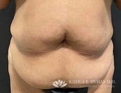 Abdominoplasty Before & After Gallery - Patient 58232328 - Image 1