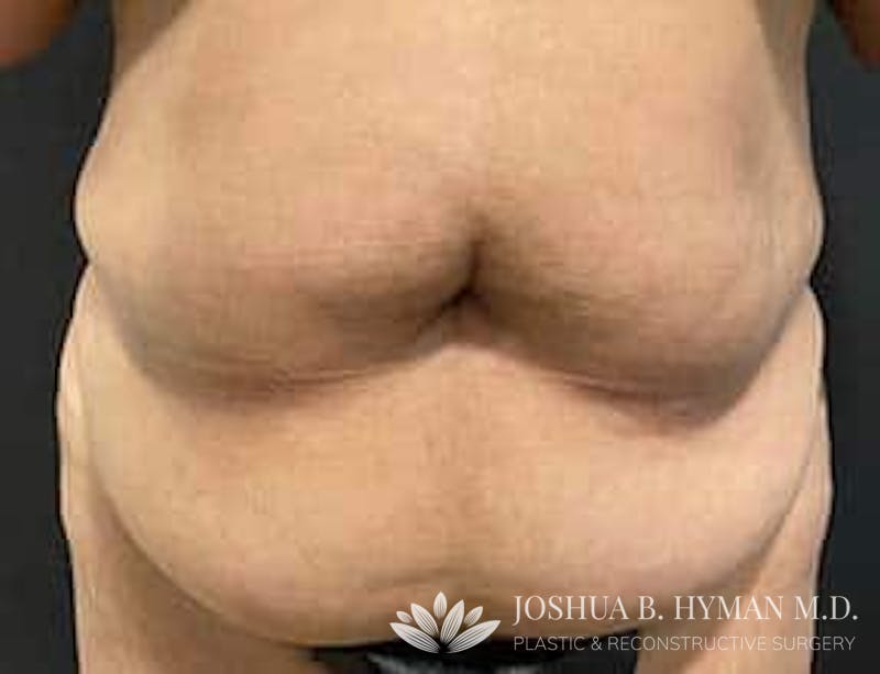 Abdominoplasty Before & After Gallery - Patient 58232328 - Image 1