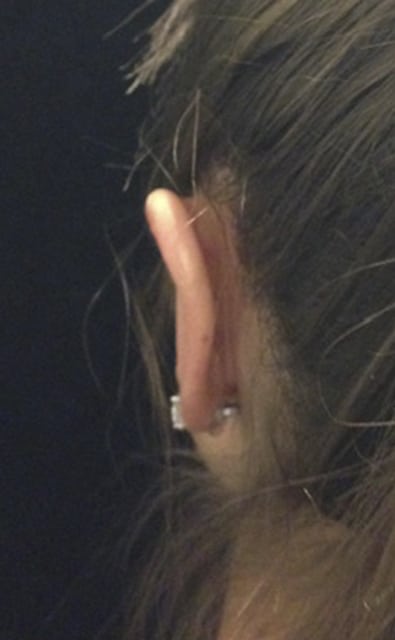 Otoplasty Before & After Gallery - Patient 58232329 - Image 2