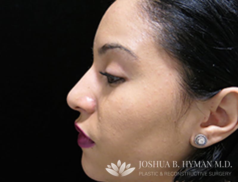 Rhinoplasty Before & After Gallery - Patient 58232330 - Image 2