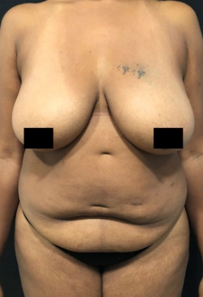 Abdominoplasty Before & After Gallery - Patient 58232332 - Image 1