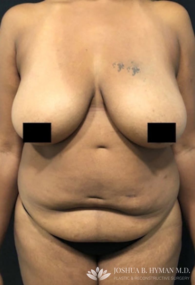 Abdominoplasty Before & After Gallery - Patient 58232332 - Image 1