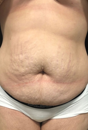 Abdominoplasty Before & After Gallery - Patient 58232337 - Image 1