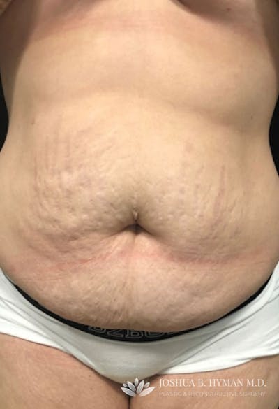 Abdominoplasty Before & After Gallery - Patient 58232337 - Image 1