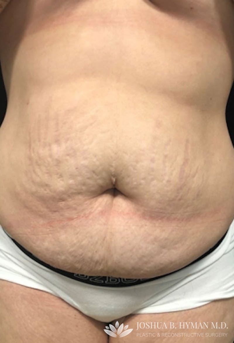 Abdominoplasty Before & After Gallery - Patient 58232337 - Image 1