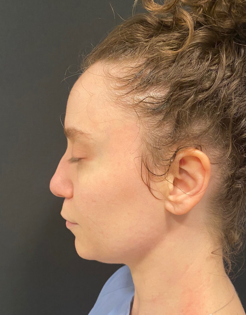 Liposuction Before & After Gallery - Patient 58232339 - Image 1