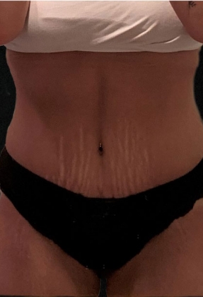 Abdominoplasty Before & After Gallery - Patient 58232337 - Image 2