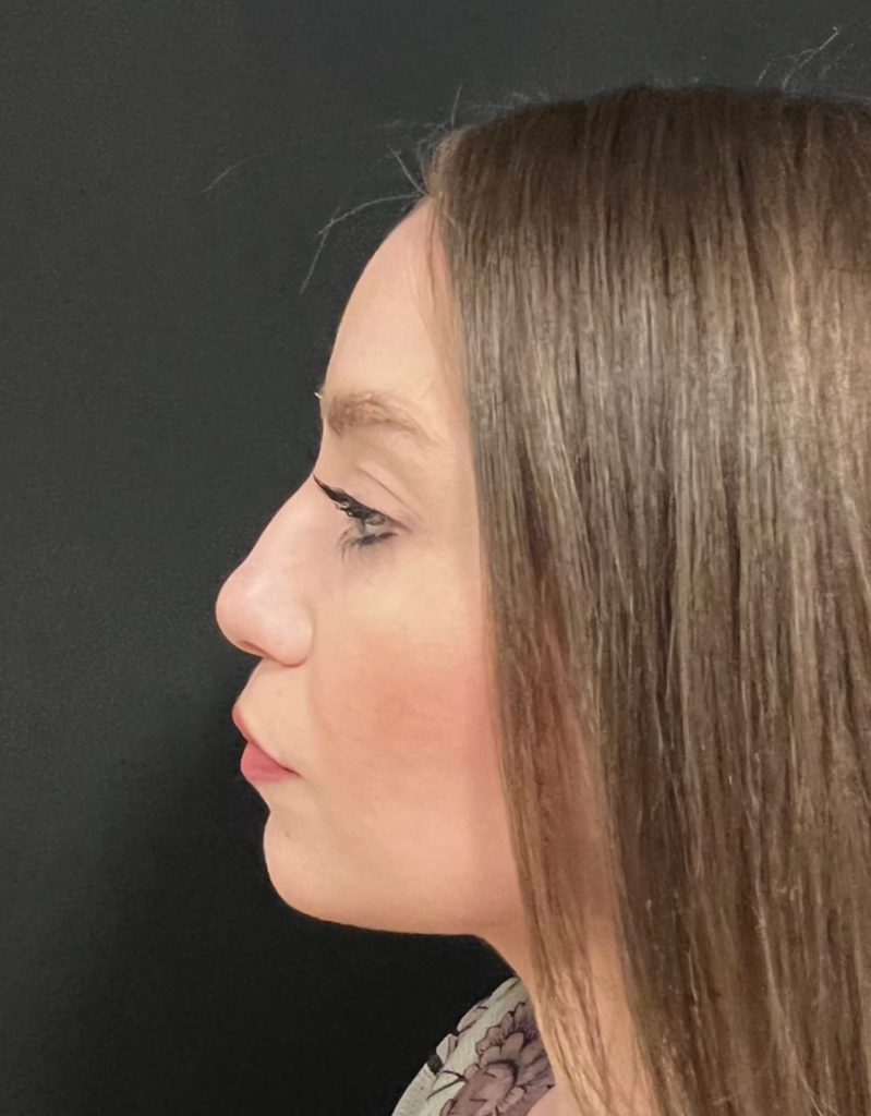 Liposuction Before & After Gallery - Patient 58232339 - Image 2