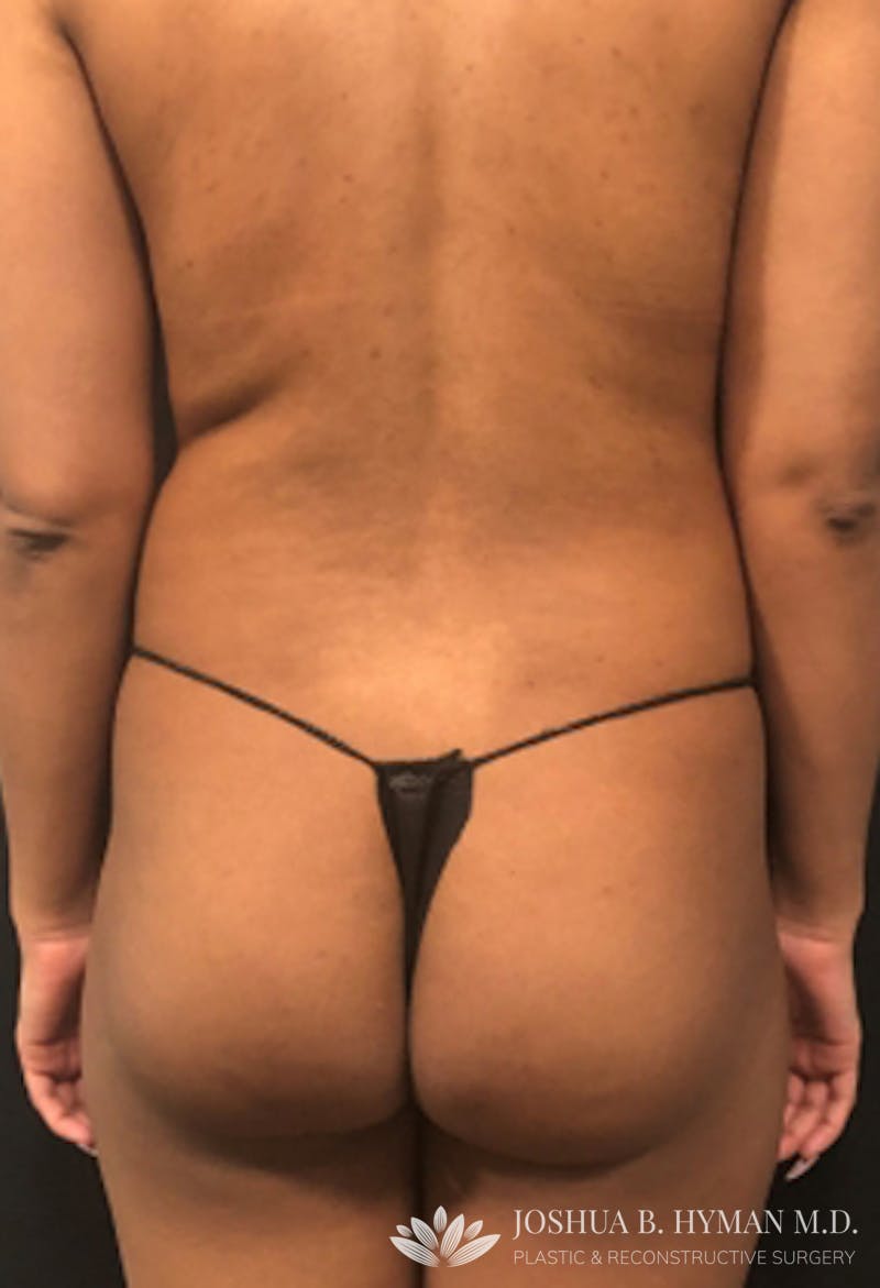 Liposuction Before & After Gallery - Patient 58232343 - Image 1