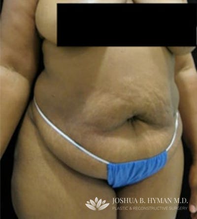Abdominoplasty Before & After Gallery - Patient 58232345 - Image 1