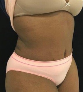 Abdominoplasty Before & After Gallery - Patient 58232345 - Image 2