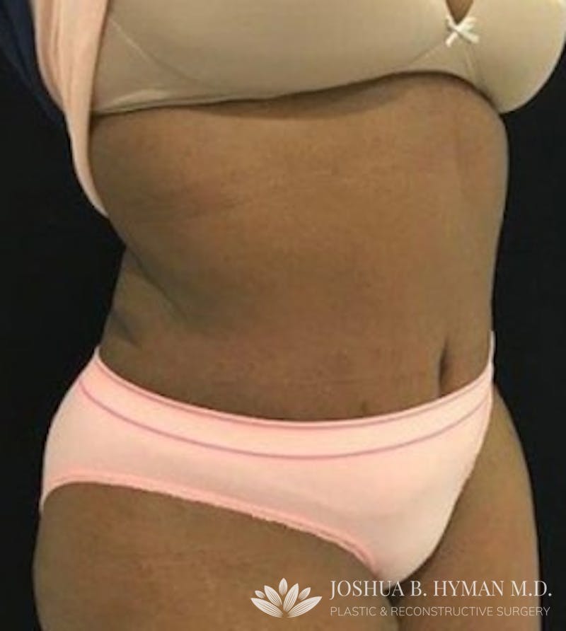 Abdominoplasty Before & After Gallery - Patient 58232345 - Image 2