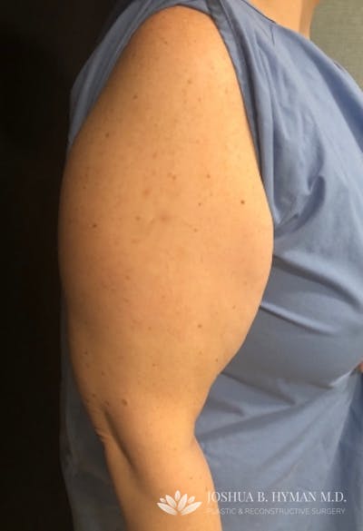 Liposuction Before & After Gallery - Patient 58232350 - Image 1