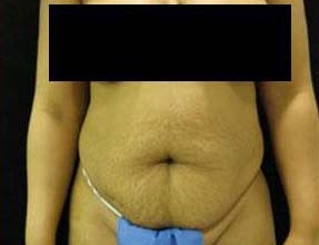 Abdominoplasty Before & After Gallery - Patient 58232351 - Image 1