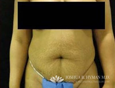 Abdominoplasty Before & After Gallery - Patient 58232351 - Image 1