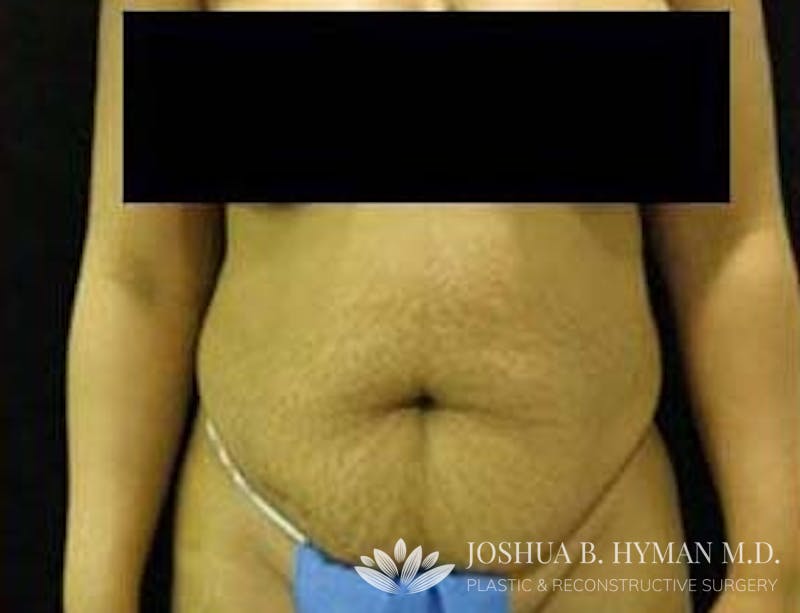 Abdominoplasty Before & After Gallery - Patient 58232351 - Image 1