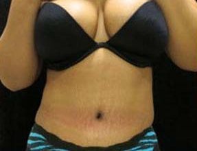 Abdominoplasty Before & After Gallery - Patient 58232351 - Image 2