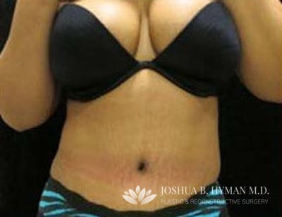 Abdominoplasty Before & After Gallery - Patient 58232351 - Image 2