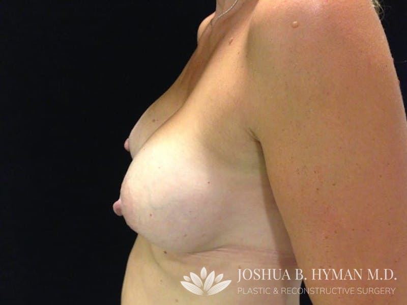 Breast Augmentation Before & After Gallery - Patient 58232352 - Image 4