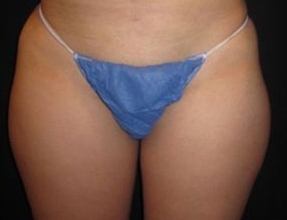 Liposuction Before & After Gallery - Patient 58232364 - Image 1