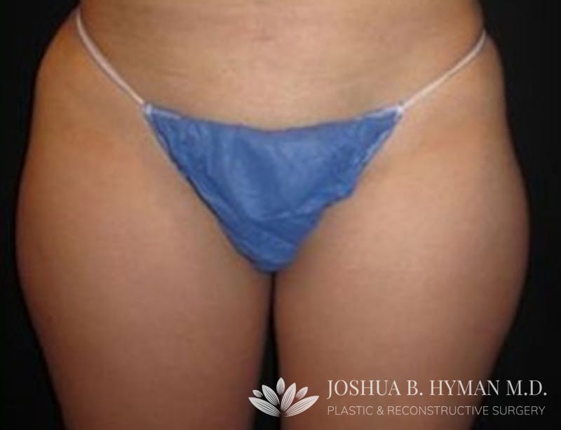 Liposuction Before & After Gallery - Patient 58232364 - Image 1