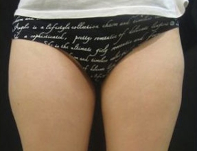 Liposuction Before & After Gallery - Patient 58232364 - Image 2