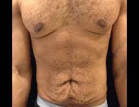 Male Abdominoplasty Before & After Gallery - Patient 300348 - Image 1