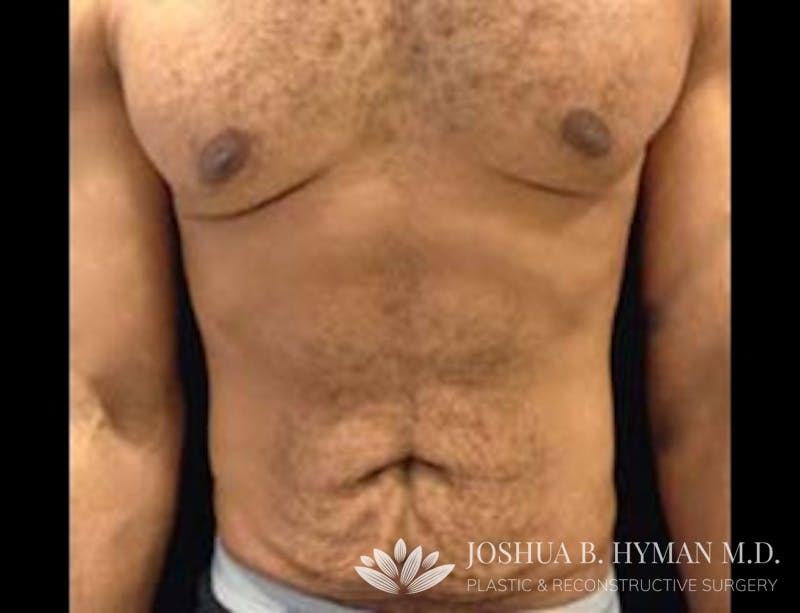Abdominoplasty Before & After Gallery - Patient 58232370 - Image 1