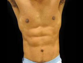 Male Abdominoplasty Before & After Gallery - Patient 300348 - Image 2