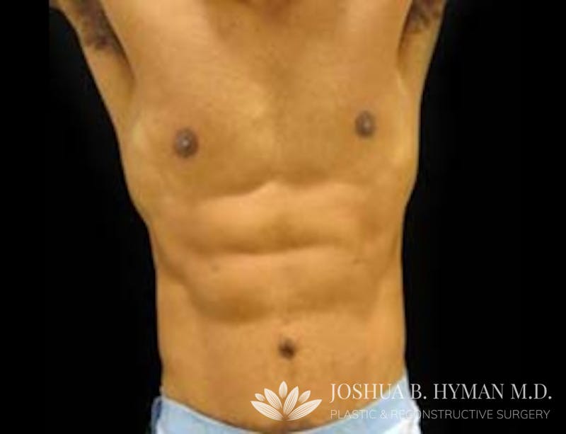 Abdominoplasty Before & After Gallery - Patient 58232370 - Image 2