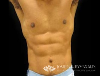 Abdominoplasty Before & After Gallery - Patient 58232370 - Image 2