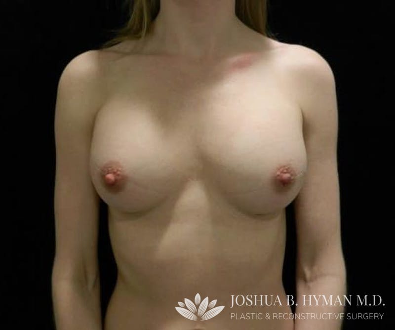 Breast Augmentation Before & After Gallery - Patient 58232374 - Image 2