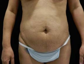 Abdominoplasty Before & After Gallery - Patient 58232373 - Image 1